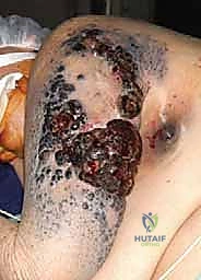 صورة توضيحية لـ استئصال الربع الأمامي: دليل شامل للمرضى مع الأستاذ الدكتور محمد هطيف