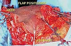صورة توضيحية لـ استئصال الربع الأمامي: دليل شامل للمرضى مع الأستاذ الدكتور محمد هطيف
