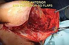 تحديد هوامش الاستئصال الآمنة