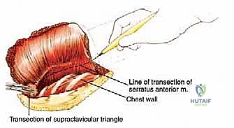 تحرير العضلات الخلفية للوح الكتف