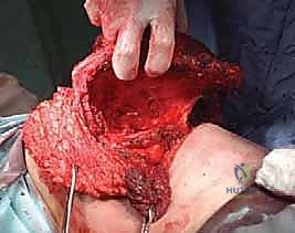 صورة طبية: استئصال الربع الأمامي: دليل شامل للمرضى مع الأستاذ الدكتور محمد هطيف