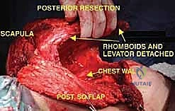 صورة طبية: استئصال الربع الأمامي: دليل شامل للمرضى مع الأستاذ الدكتور محمد هطيف