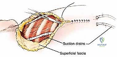 صورة توضيحية لـ استئصال الربع الأمامي: دليل شامل للمرضى مع الأستاذ الدكتور محمد هطيف