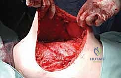 Forequarter Amputation: An Intraoperative Masterclass in Advanced Oncologic Resection