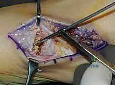 عملية لابيدوس: الحل الجذري لإبهام القدم الأروح المعقد في صنعاء