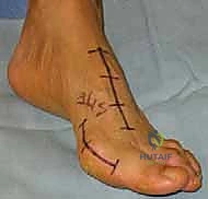 Mastering the Lapidus Procedure: A Comprehensive Intraoperative Guide