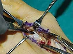 التشريح الميكانيكي للقدم والمفصل الرسغي المشطي الأول