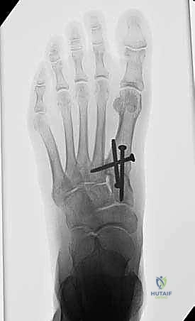 برنامج إعادة التأهيل والعلاج الطبيعي بعد عملية لابيدوس