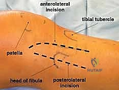 صورة توضح آلية الإصابة وانخساف العظم