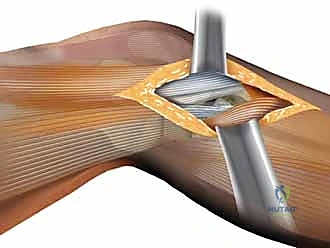 توزيع الحمل الميكانيكي على الهضبة الظنبوبية