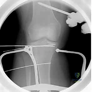 صورة أشعة بعد العملية توضح الاستعادة المثالية للسطح المفصلي