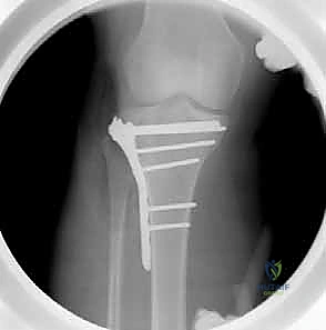 التخطيط الجراحي باستخدام الأشعة المقطعية ثلاثية الأبعاد