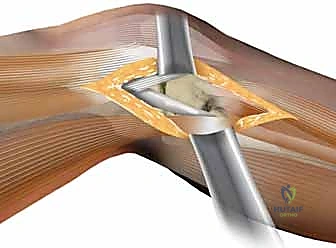 الأشعة السينية تظهر كسر انخسافي في الهضبة الظنبوبية الجانبية