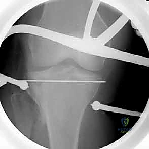 تمارين العلاج الطبيعي لاستعادة المدى الحركي للركبة