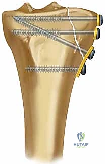استخدام المسامير والترقيع العظمي لدعم السطح المفصلي