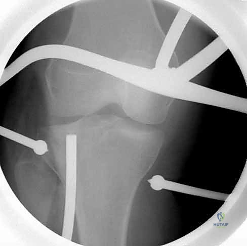 تثبيت الكسر باستخدام الشريحة التشريحية الداعمة LCP