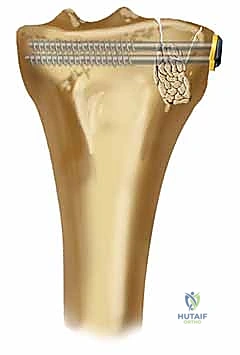 كسر الهضبة الظنبوبية الجانبية: دليل شامل للعلاج والتعافي مع الأستاذ الدكتور محمد هطيف