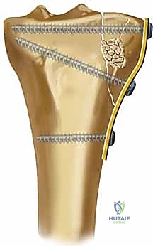Masterclass: Open Reduction and Internal Fixation of Lateral Tibial Plateau Fractures