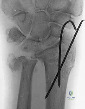 رأس الزند يشكل نقطة الارتكاز التي تستند عليها اليد والكعبرة