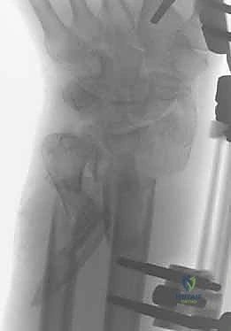 علاج كسور عظم الزند: دليل شامل لكسور الناتئ الإبري، الرأس، والجزء الكردوسي الكردوسي مع الأستاذ الدكتور محمد هطيف في صنعاء