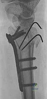 الأشعة المقطعية توفر تفاصيل دقيقة للكسر