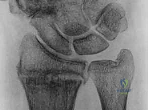 التخطيط الجراحي لكسور الزند