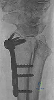 صورة توضح الفرق بين التثبيت الداخلي والجبس