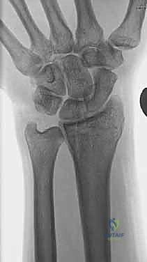 صورة توضيحية لـ علاج كسور عظم الزند: دليل شامل لكسور الناتئ الإبري، الرأس، والجزء الكردوسي الكردوسي مع الأستاذ الدكتور محمد هطيف في صنعاء