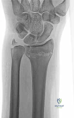 صورة توضيحية لـ علاج كسور عظم الزند: دليل شامل لكسور الناتئ الإبري، الرأس، والجزء الكردوسي الكردوسي مع الأستاذ الدكتور محمد هطيف في صنعاء
