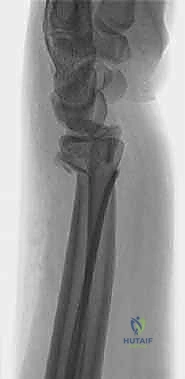 صورة طبية: علاج كسور عظم الزند: دليل شامل لكسور الناتئ الإبري، الرأس، والجزء الكردوسي الكردوسي مع الأستاذ الدكتور محمد هطيف في صنعاء