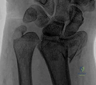صورة توضيحية لـ علاج كسور عظم الزند: دليل شامل لكسور الناتئ الإبري، الرأس، والجزء الكردوسي الكردوسي مع الأستاذ الدكتور محمد هطيف في صنعاء