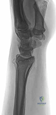 صورة طبية: علاج كسور عظم الزند: دليل شامل لكسور الناتئ الإبري، الرأس، والجزء الكردوسي الكردوسي مع الأستاذ الدكتور محمد هطيف في صنعاء