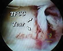 صورة توضيحية لـ علاج كسور عظم الزند: دليل شامل لكسور الناتئ الإبري، الرأس، والجزء الكردوسي الكردوسي مع الأستاذ الدكتور محمد هطيف في صنعاء