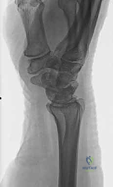 صورة طبية: علاج كسور عظم الزند: دليل شامل لكسور الناتئ الإبري، الرأس، والجزء الكردوسي الكردوسي مع الأستاذ الدكتور محمد هطيف في صنعاء