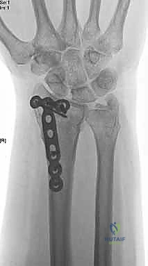 صورة طبية: علاج كسور عظم الزند: دليل شامل لكسور الناتئ الإبري، الرأس، والجزء الكردوسي الكردوسي مع الأستاذ الدكتور محمد هطيف في صنعاء