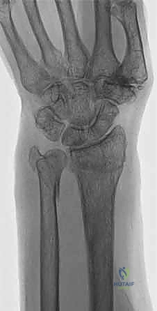 صورة طبية: علاج كسور عظم الزند: دليل شامل لكسور الناتئ الإبري، الرأس، والجزء الكردوسي الكردوسي مع الأستاذ الدكتور محمد هطيف في صنعاء