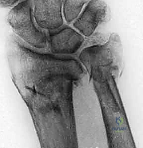 صورة توضيحية لـ علاج كسور عظم الزند: دليل شامل لكسور الناتئ الإبري، الرأس، والجزء الكردوسي الكردوسي مع الأستاذ الدكتور محمد هطيف في صنعاء