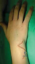 صورة طبية توضح كسر الناتئ الإبري