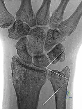 صورة لكسر في رأس الزند