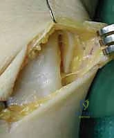 صور الرنين المغناطيسي لتقييم الأربطة