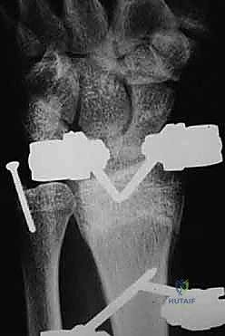 صورة طبية: علاج كسور عظم الزند: دليل شامل لكسور الناتئ الإبري، الرأس، والجزء الكردوسي الكردوسي مع الأستاذ الدكتور محمد هطيف في صنعاء