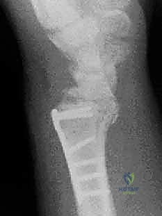 صورة طبية: علاج كسور عظم الزند: دليل شامل لكسور الناتئ الإبري، الرأس، والجزء الكردوسي الكردوسي مع الأستاذ الدكتور محمد هطيف في صنعاء