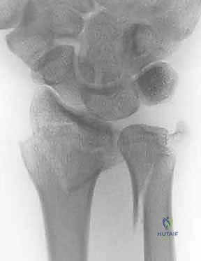 صورة طبية: علاج كسور عظم الزند: دليل شامل لكسور الناتئ الإبري، الرأس، والجزء الكردوسي الكردوسي مع الأستاذ الدكتور محمد هطيف في صنعاء