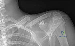 Illustration of plate fixation of clavicle - Dr. Mohammed Hutaif
