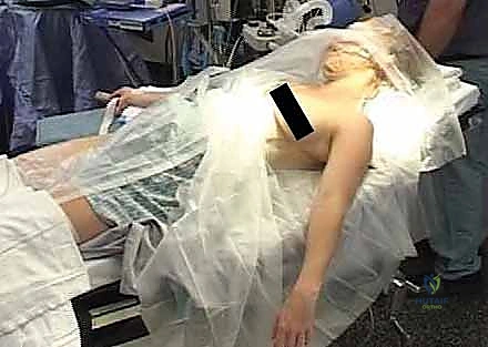 تحديد مكان الشق الجراحي بدقة لتجنب الأعصاب السطحية