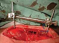 صورة توضيحية لـ تثبيت كسر الترقوة بالصفيحة والمسامير: دليل شامل للمرضى مع الأستاذ الدكتور محمد هطيف