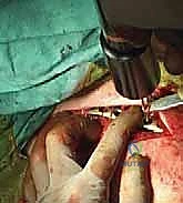 وضع الصفيحة المعدنية على عظم الترقوة وتثبيتها المبدئي