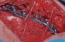 إعادة محاذاة العظم المكسور إلى وضعه التشريحي الطبيعي