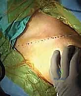 كشف حواف العظم المكسور وإزالة الأنسجة المتداخلة