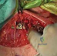 تثبيت كسر الترقوة بالصفيحة والمسامير: دليل شامل للمرضى مع الأستاذ الدكتور محمد هطيف